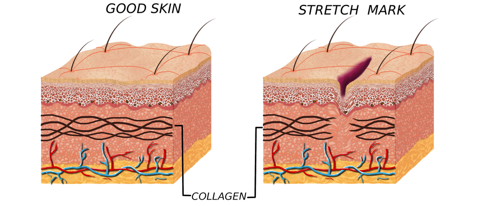 Get Rid Of Stretch Marks For Good National Laser Institute Medical Spa