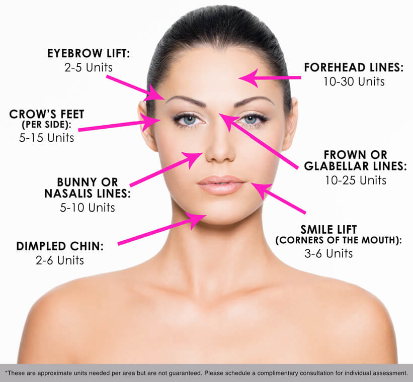 Printable Botox Injection Face Map