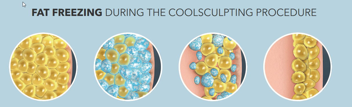 fat-freezing-cross-section