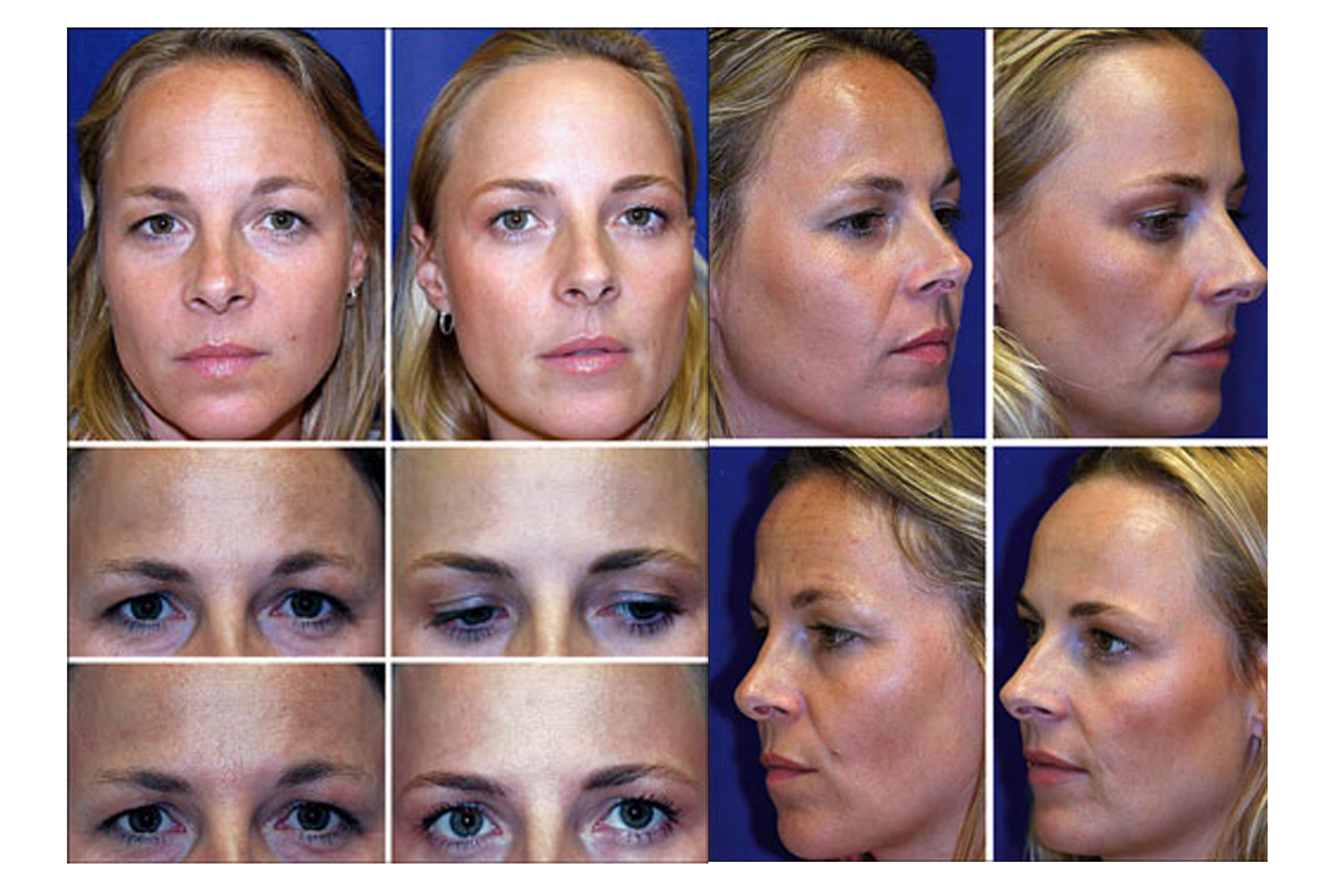 New Study Proves Botox Freezes The Aging Process National Laser 