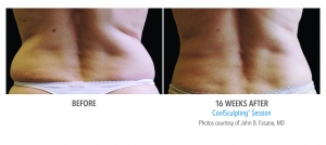 CoolSculpting