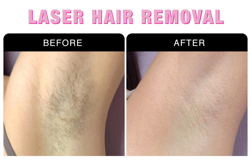 Laser Hair Removal