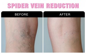 Spider Vein Treatment in Brampton