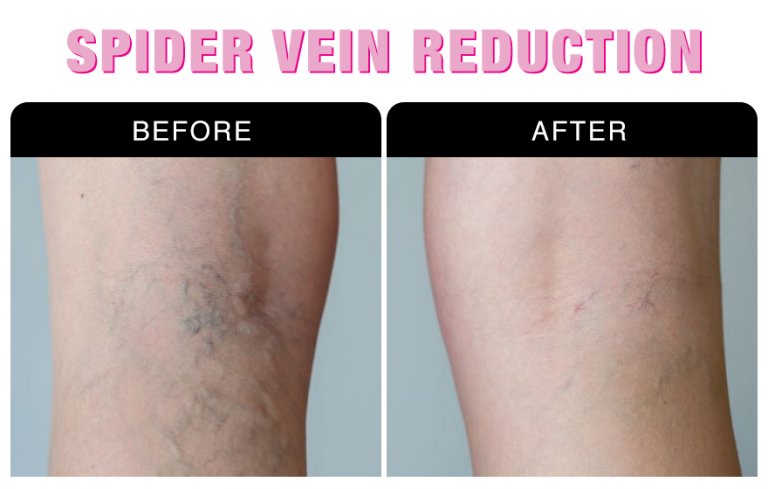 Spider Vein Removal Treatment With Sclerotherapy National Laser