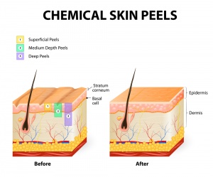 Chemical Peel Reviews Scottsdale + Dallas_2