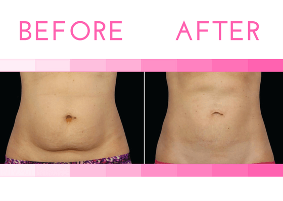 CoolSculpting® Success in Texas - American Laser Med Spa