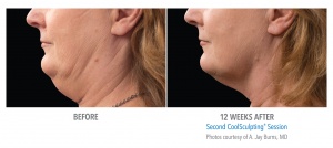 CoolSculpting For Double Chin Removal