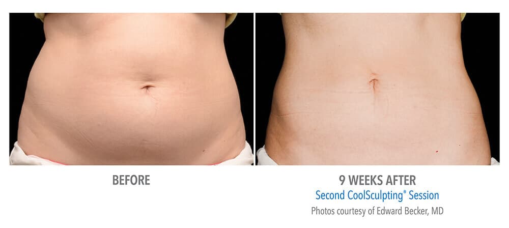 cool-sculpting-before-after-1