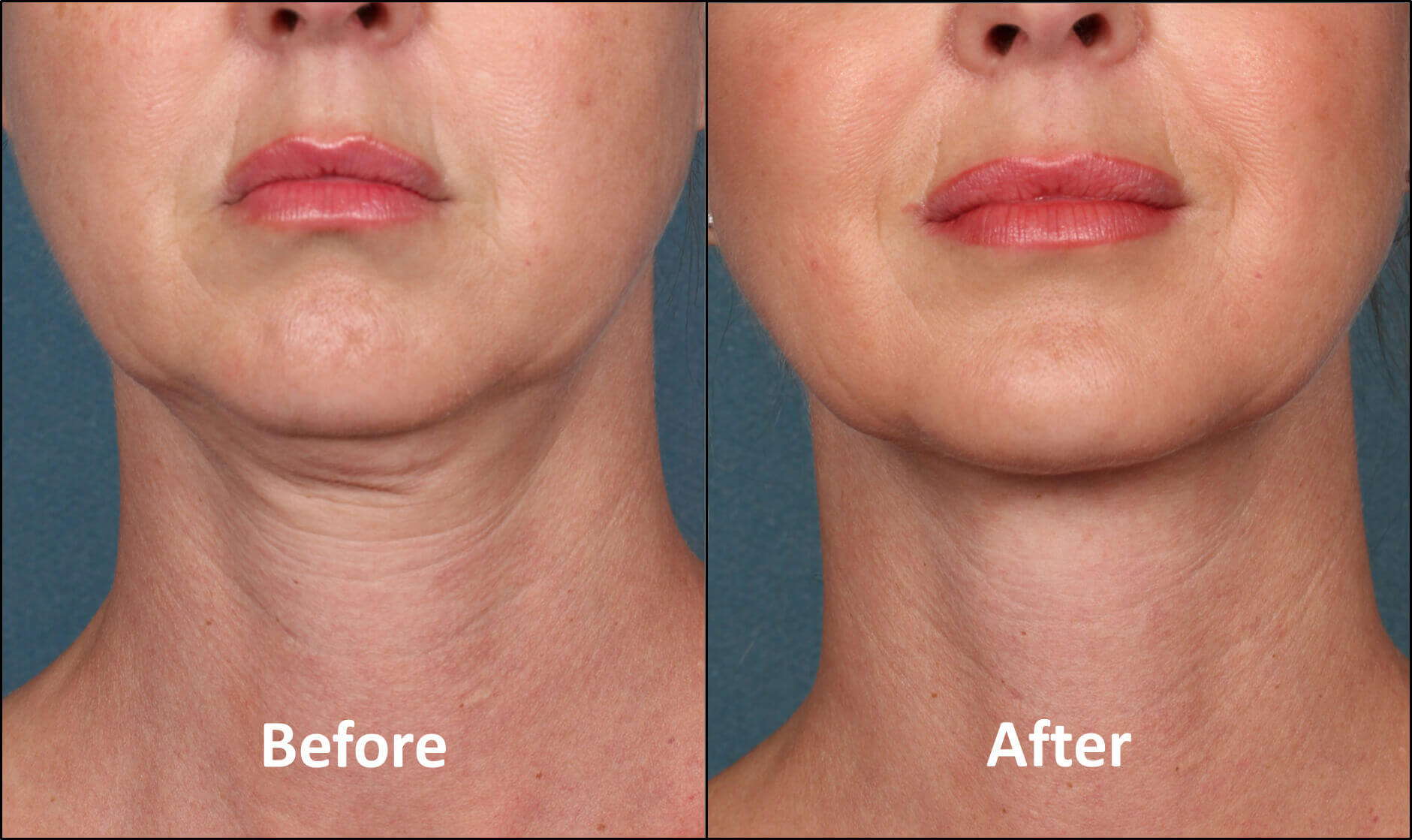 Kybella Patient Before and After