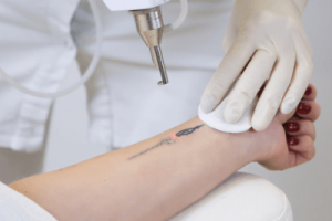 cost tattoo removal