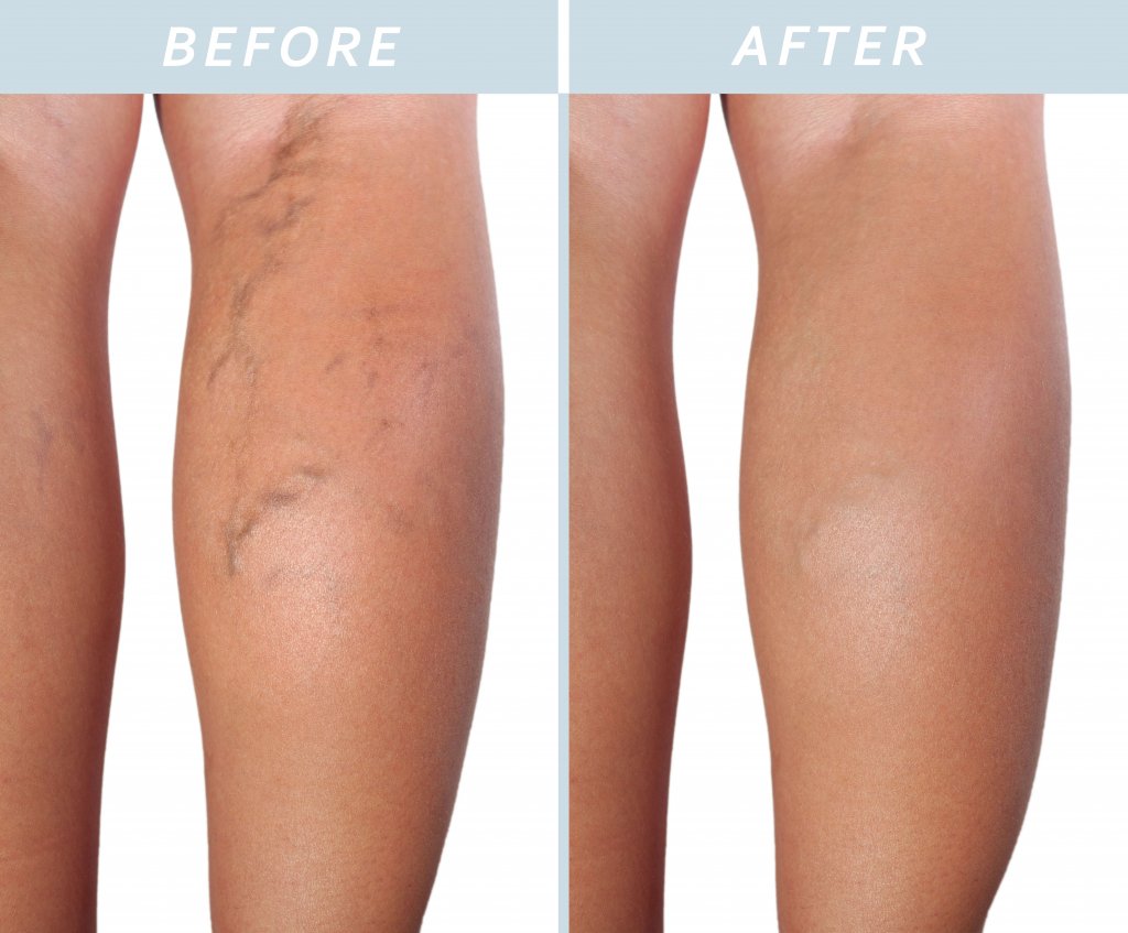 How Long Do I Wear Compression Stockings After Spider Vein Treatment?