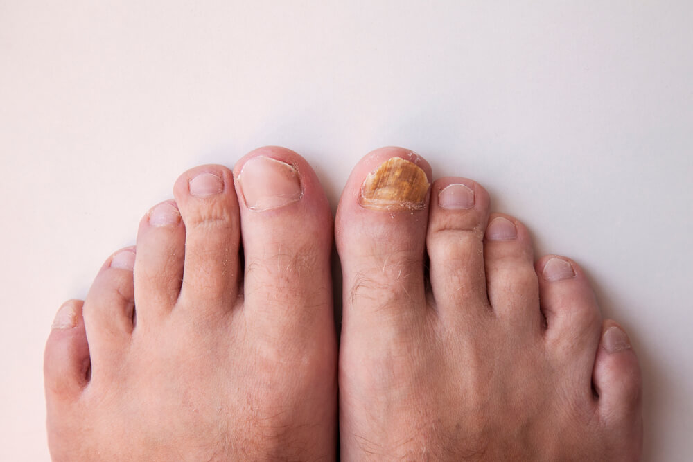 Toenail Fungus Removal In Dallas Texas National Laser Institute 