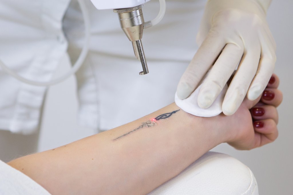 Laser Tattoo Removal Procedure, Benefits, and Risks - Blog - Aura Skin  Institute
