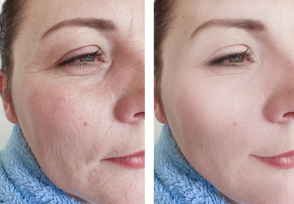 Radiofrequency Skin Rejuvenation Procedures in Phoenix - National Laser ...