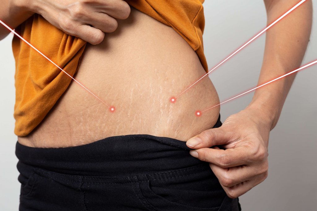 laser-stretch-mark-removal-az-national-laser-institute-medical-spa