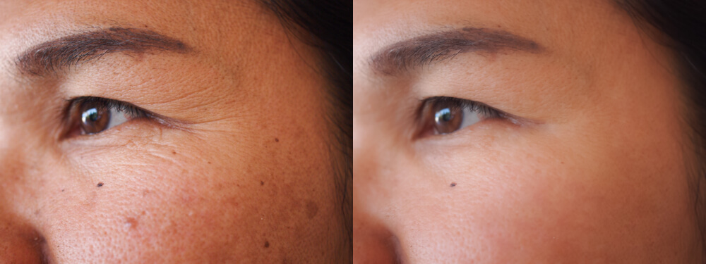 Age Spot Removal - National Laser Institute Medical Spa