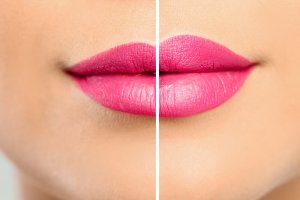 lip enhancement PDO threads