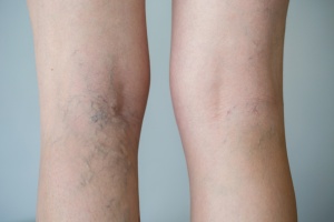 spider veins before and after