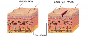 Do Stretch Mark Removal Laser Treatments Work?