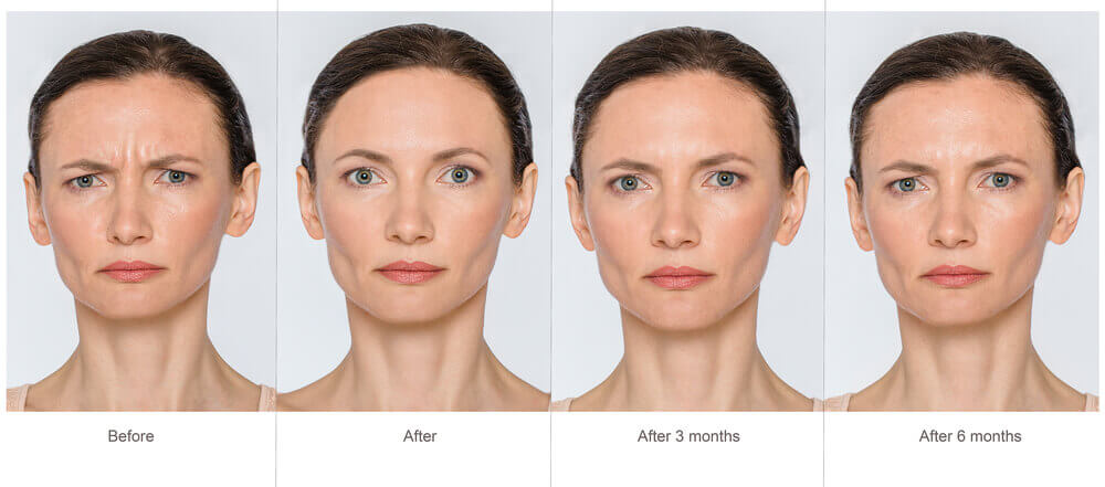 Natural Botox Injections That Last