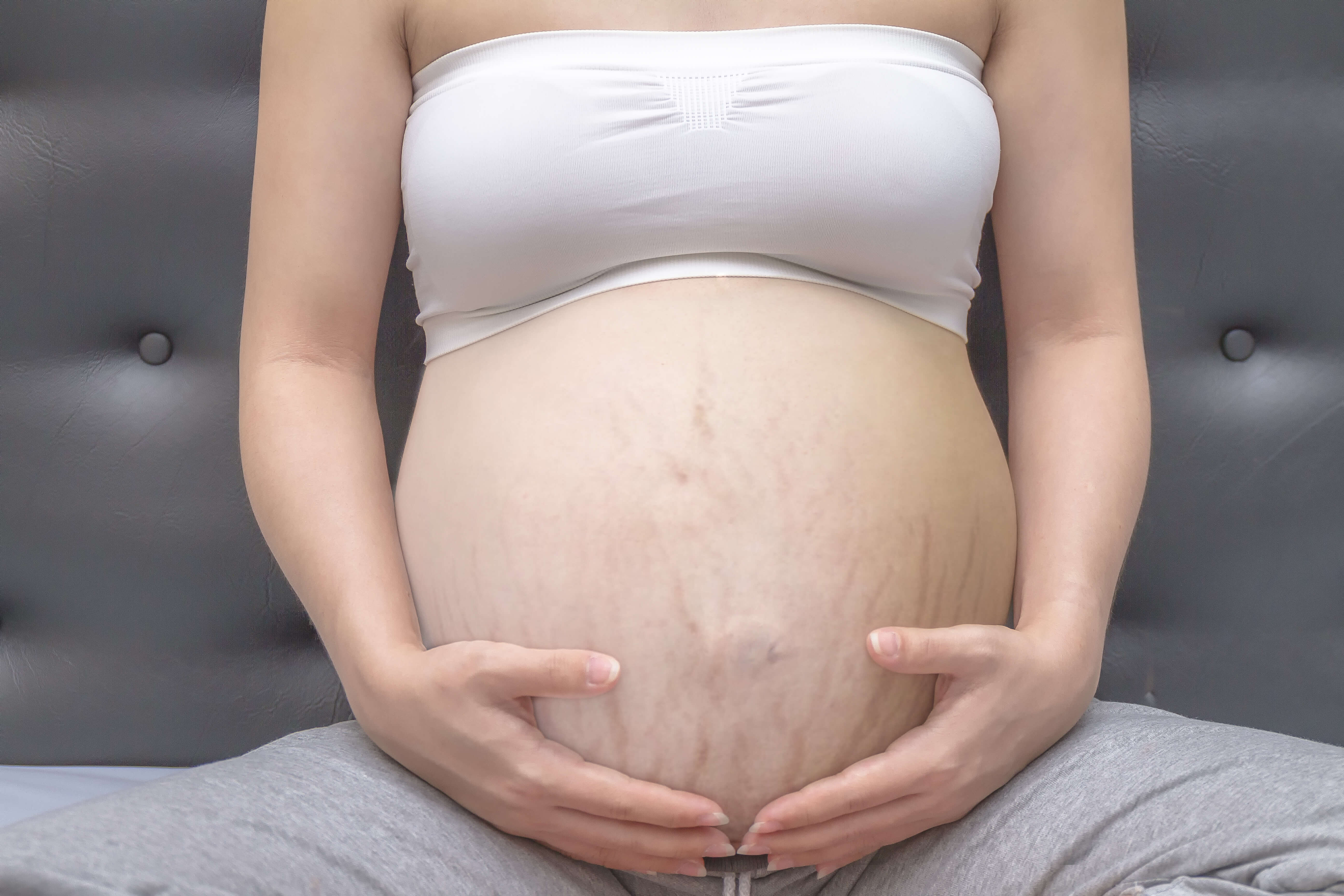 Трещина после родов. Беременный живот с растяжками. Растяжки при беременности. Растяжки на животе беременность.