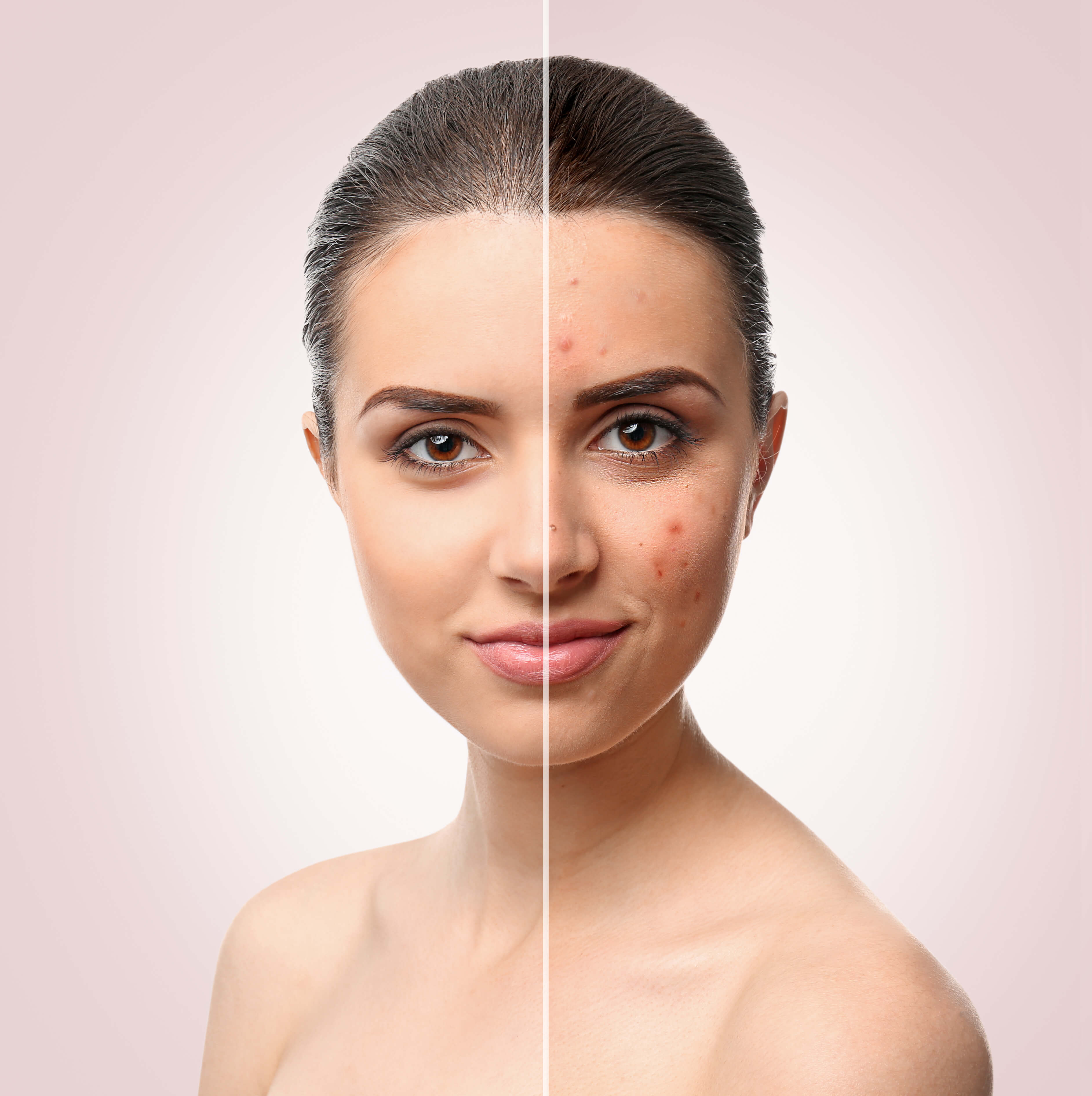 Acne reduction treatments in Dallas National Laser Institute