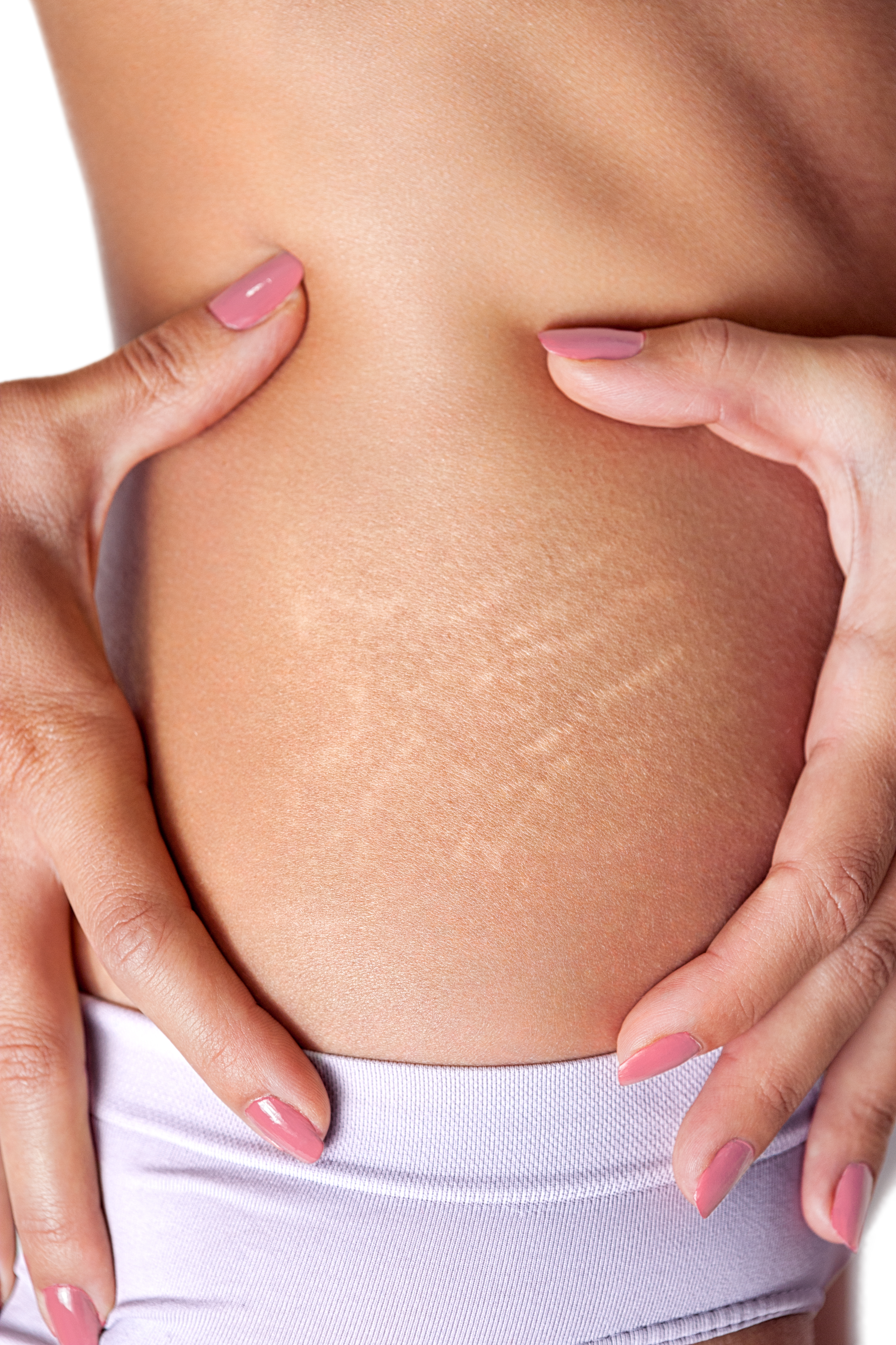 Stretch Mark Reduction in Dallas - National Laser Institute Medical Spa