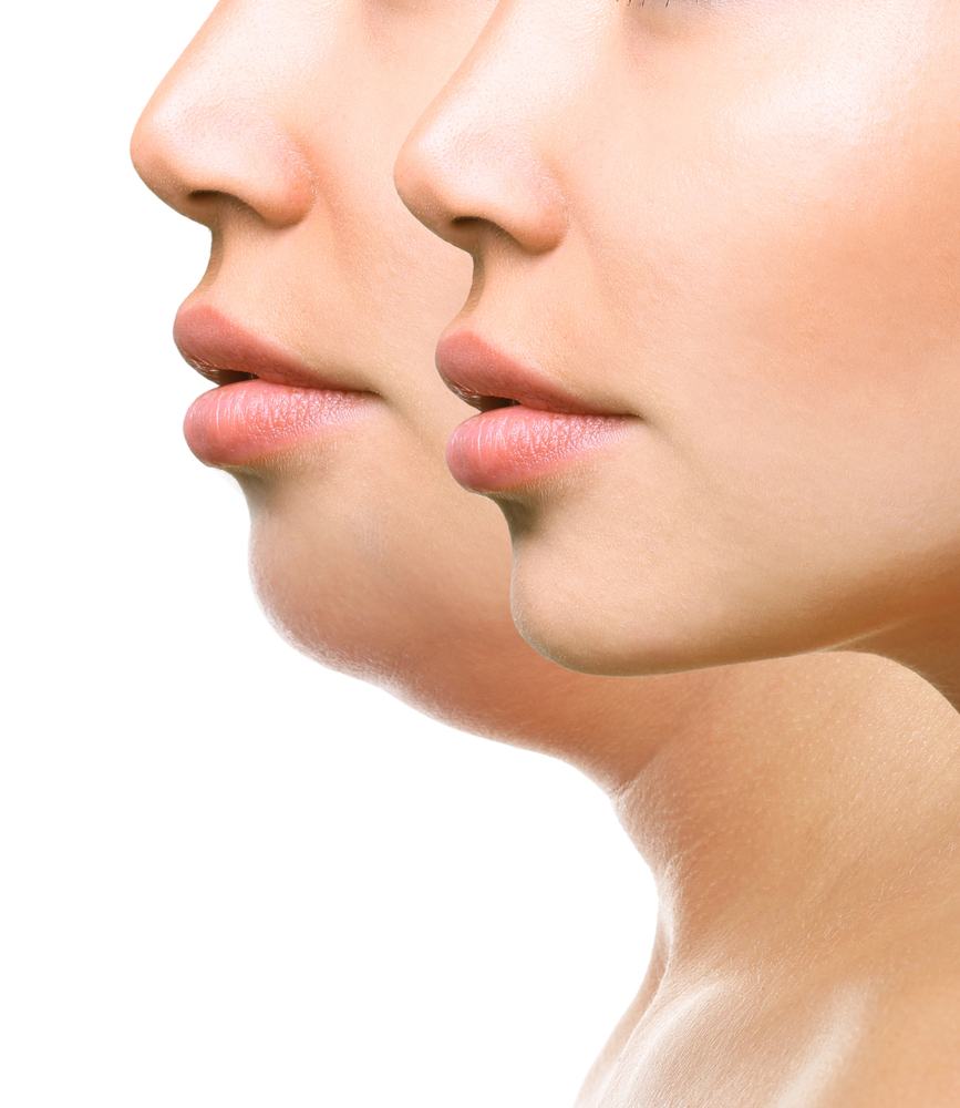 Kybella in Scottsdale