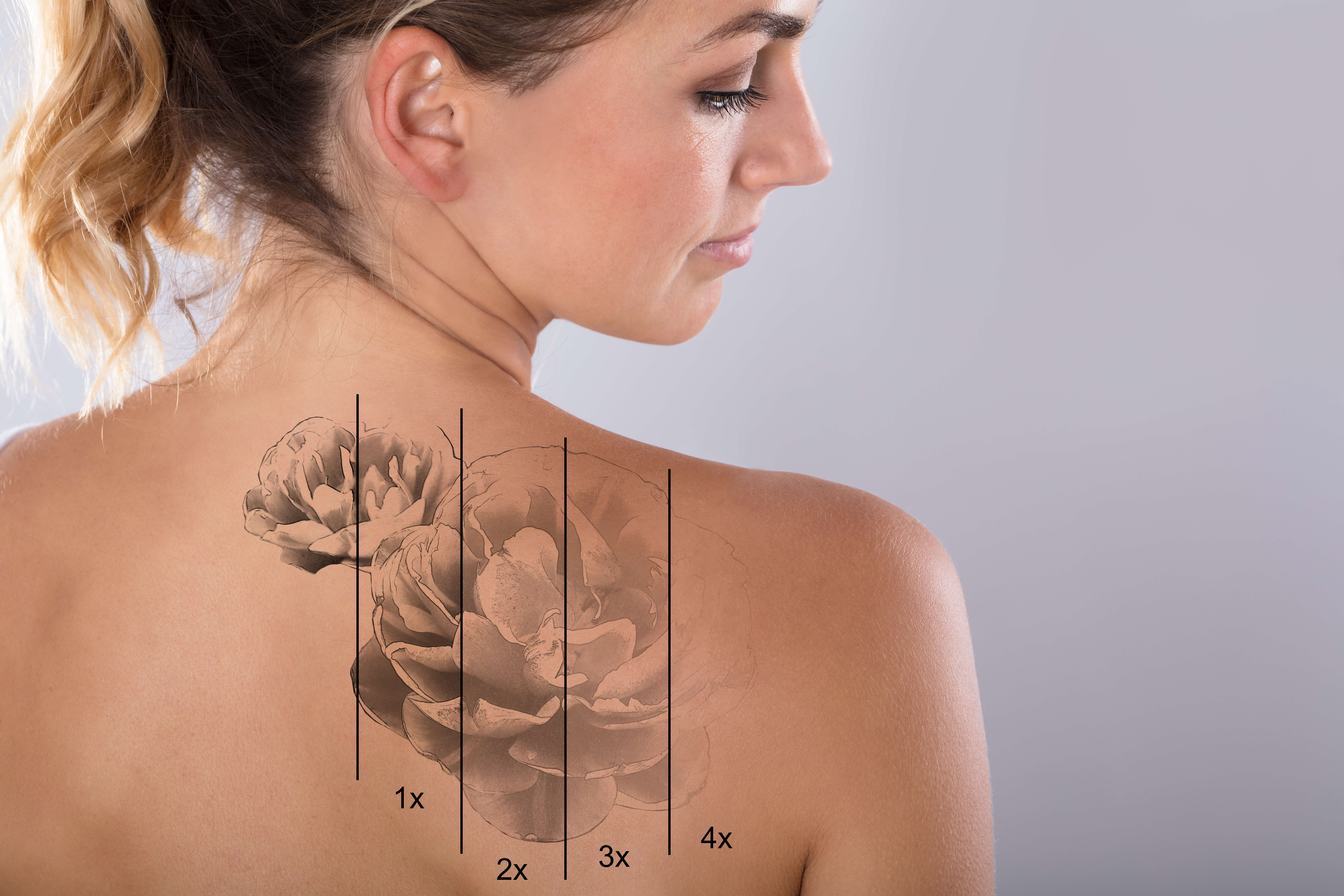 Tattoo Removal in Dallas TX - National Laser Institute Medical Spa